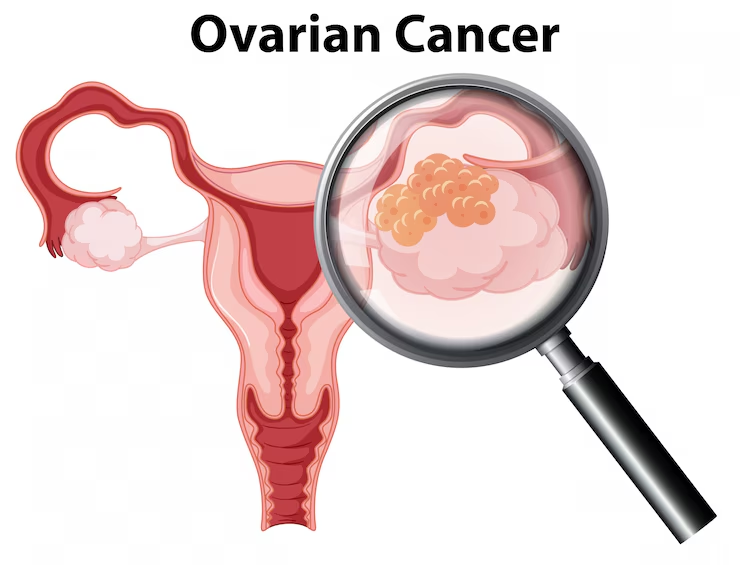 Ovarian Cancer